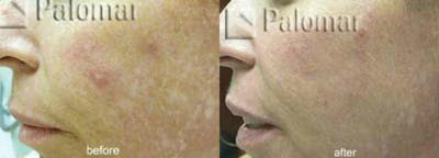 Laser Resurfacing Before & After Gallery - Patient 38307344 - Image 1