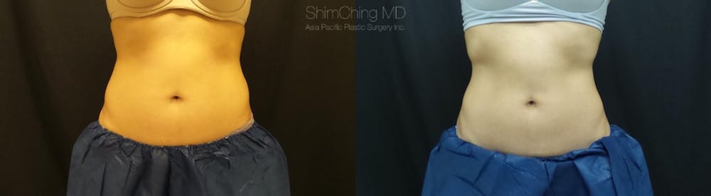 CoolSculpting Before & After Gallery - Patient 38307345 - Image 1