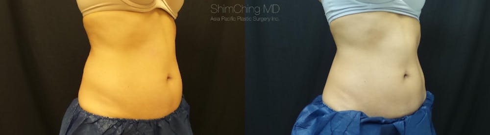 CoolSculpting Before & After Gallery - Patient 38307345 - Image 2