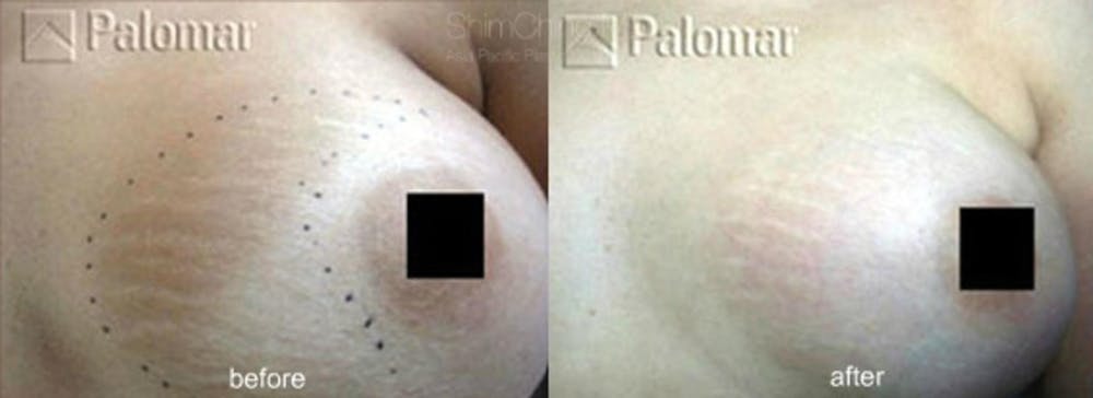 Laser Resurfacing Before & After Gallery - Patient 38307347 - Image 1