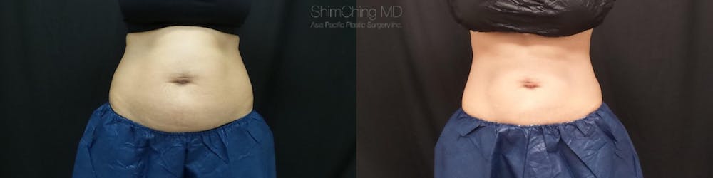 CoolSculpting Before & After Gallery - Patient 38307350 - Image 1