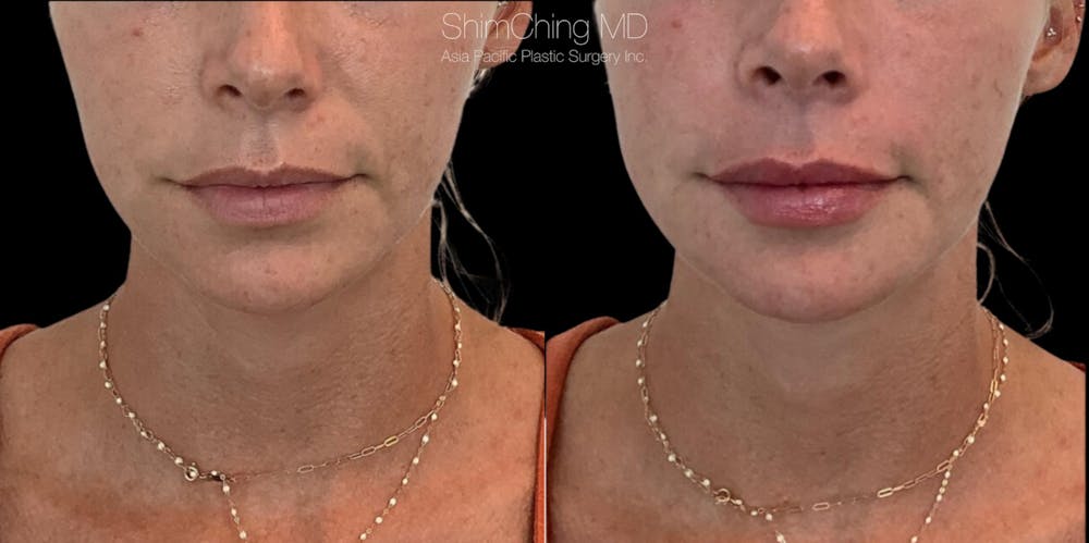 Dermal Fillers Before & After Gallery - Patient 38307348 - Image 1