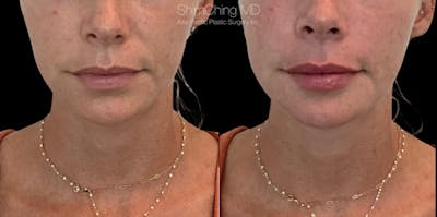 Dermal Fillers Before & After Gallery - Patient 38307348 - Image 1