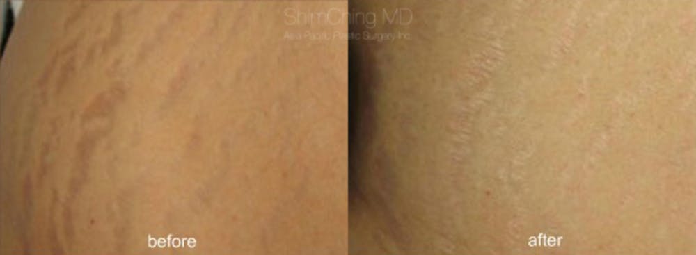 Laser Resurfacing Before & After Gallery - Patient 38307349 - Image 1