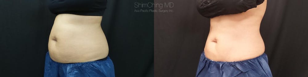 CoolSculpting Before & After Gallery - Patient 38307350 - Image 2