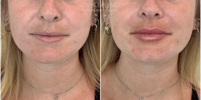Dermal Fillers Before & After Gallery - Patient 38307353 - Image 1