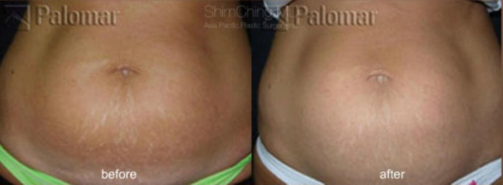 Laser Resurfacing Before & After Gallery - Patient 38307352 - Image 1