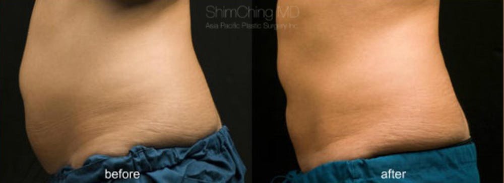 CoolSculpting Before & After Gallery - Patient 38307354 - Image 1