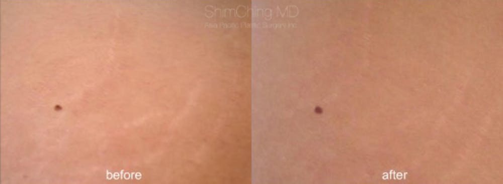 Laser Resurfacing Before & After Gallery - Patient 38307355 - Image 1
