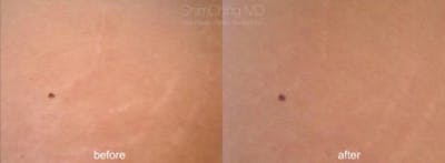 Laser Resurfacing Before & After Gallery - Patient 38307355 - Image 1