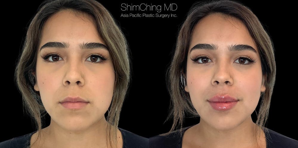 Dermal Fillers Before & After Gallery - Patient 38307356 - Image 1