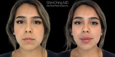 Dermal Fillers Before & After Gallery - Patient 38307356 - Image 1