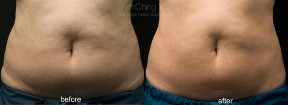 CoolSculpting Before & After Gallery - Patient 38307361 - Image 1