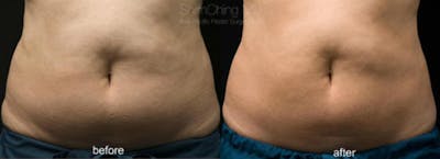 CoolSculpting Before & After Gallery - Patient 38307361 - Image 1