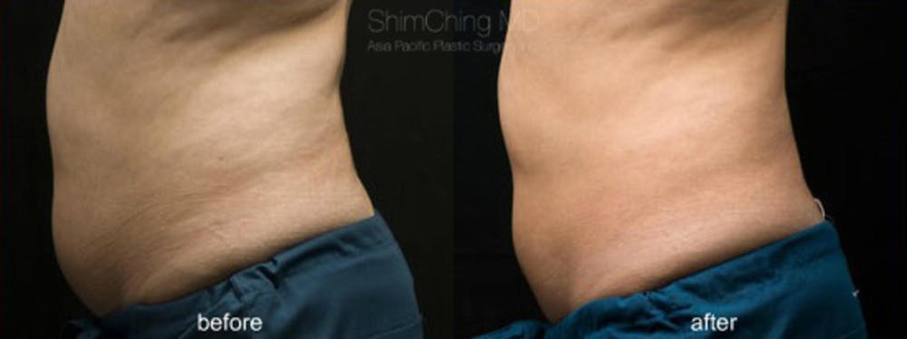 CoolSculpting Before & After Gallery - Patient 38307361 - Image 2