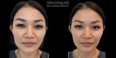 Kybella Before & After Gallery - Patient 38307375 - Image 1