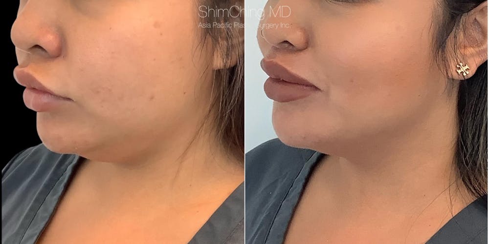 Kybella Before & After Gallery - Patient 38307376 - Image 1