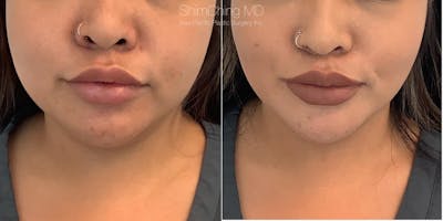 Kybella Before & After Gallery - Patient 38307376 - Image 2