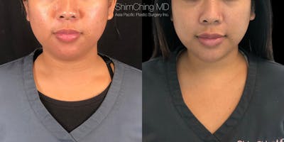 Kybella Before & After Gallery - Patient 38307389 - Image 1