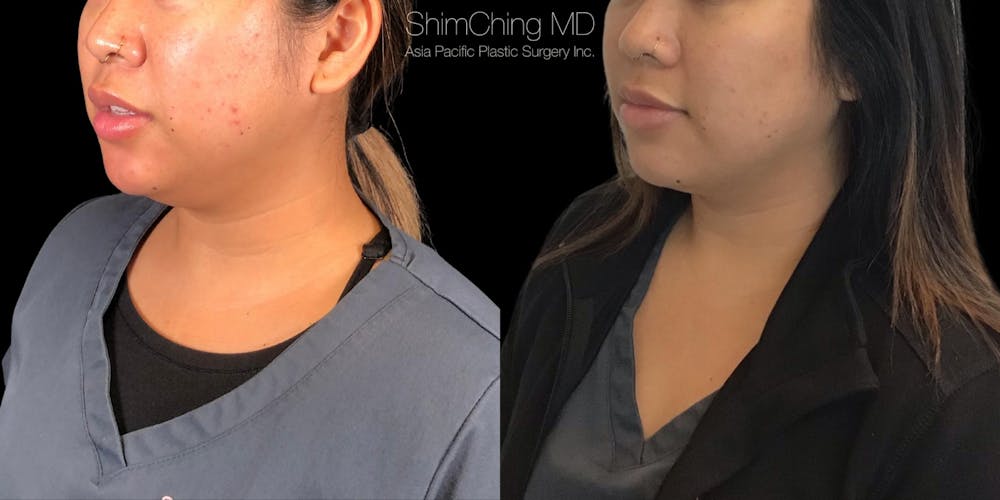 Kybella Before & After Gallery - Patient 38307389 - Image 2