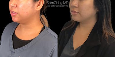 Kybella Before & After Gallery - Patient 38307389 - Image 2