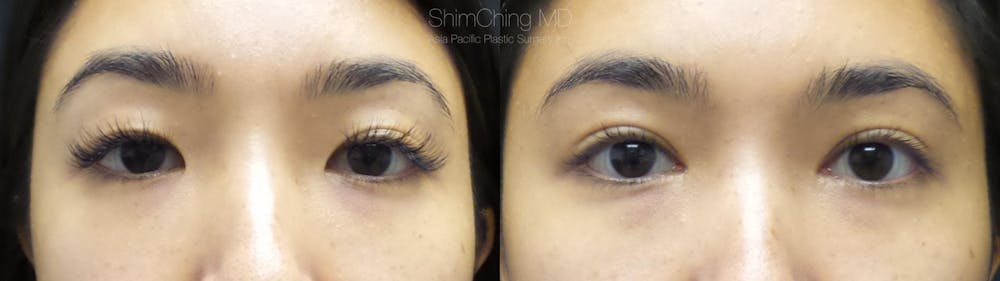 Asian Eyelid Before & After Gallery - Patient 38307390 - Image 1