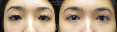 Asian Eyelid Before & After Gallery - Patient 38307390 - Image 1