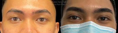 Asian Eyelid Before & After Gallery - Patient 38307394 - Image 1