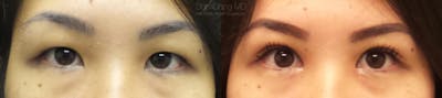 Asian Eyelid Before & After Gallery - Patient 38307396 - Image 1