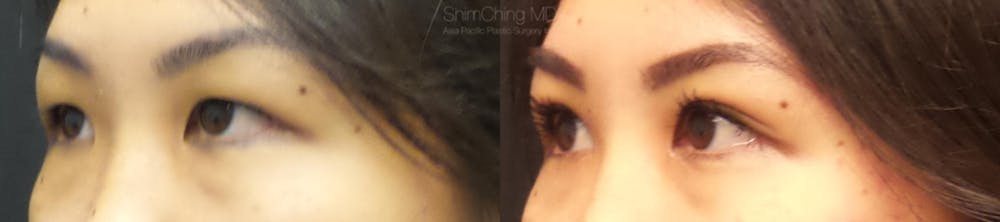 Asian Eyelid Before & After Gallery - Patient 38307396 - Image 2