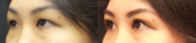 Asian Eyelid Gallery - Patient 38307396 - Image 2
