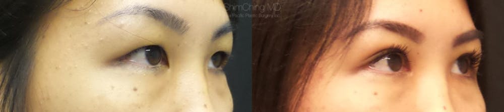 Asian Eyelid Before & After Gallery - Patient 38307396 - Image 3