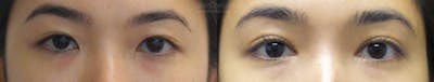 Asian Eyelid Before & After Gallery - Patient 38307397 - Image 1
