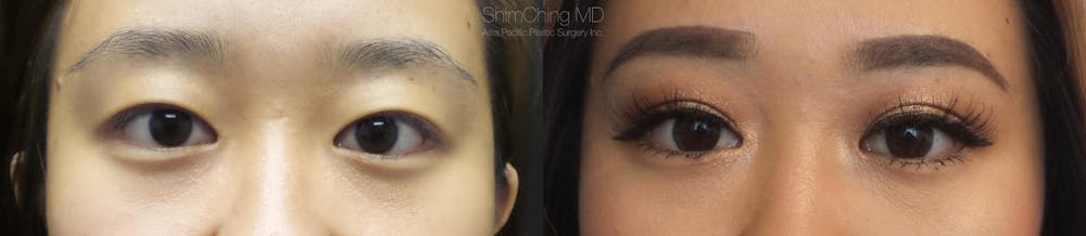 Asian Eyelid Before & After Gallery - Patient 38307400 - Image 1