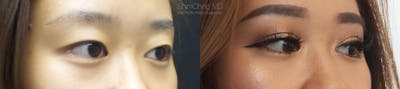 Asian Eyelid Before & After Gallery - Patient 38307400 - Image 2