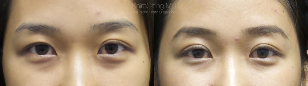 Asian Eyelid Before & After Gallery - Patient 38307401 - Image 1