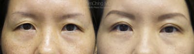 Asian Eyelid Before & After Gallery - Patient 38307404 - Image 1