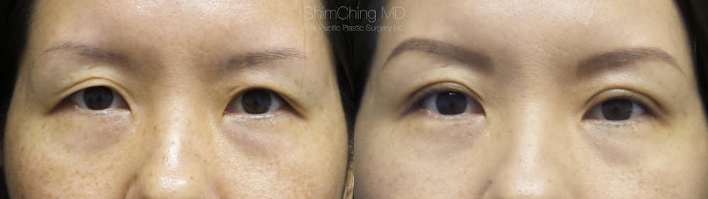 Asian Eyelid Gallery - Patient 38307404 - Image 1