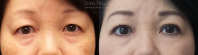 Asian Eyelid Before & After Gallery - Patient 38307405 - Image 1