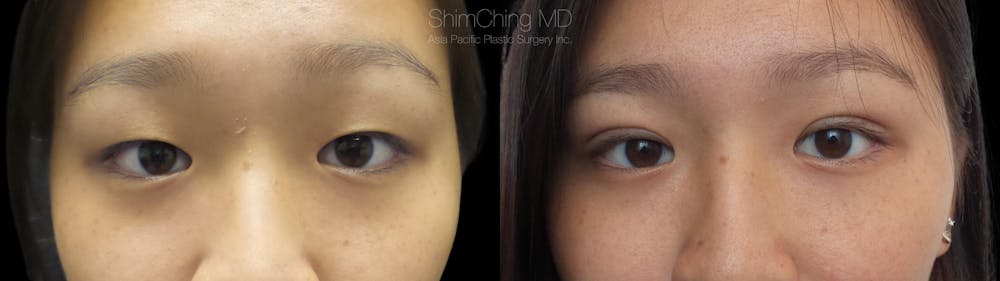 Asian Eyelid Before & After Gallery - Patient 38307408 - Image 1