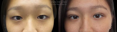 Asian Eyelid Before & After Gallery - Patient 38307408 - Image 1