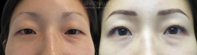 Asian Eyelid Before & After Gallery - Patient 38307411 - Image 1