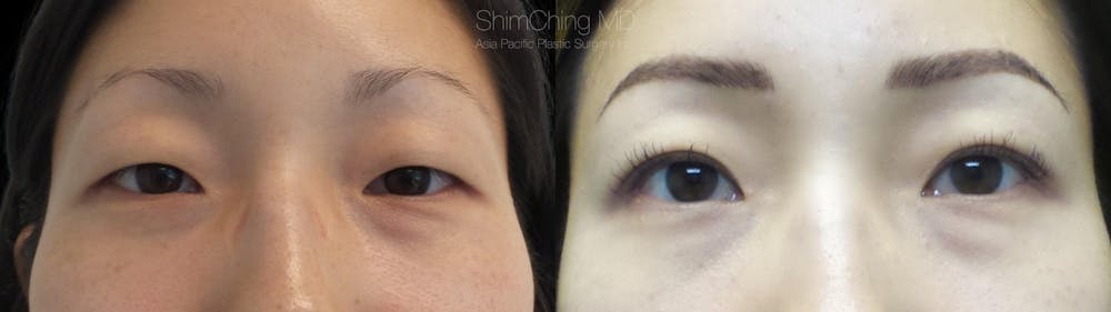 Asian Eyelid Gallery - Patient 38307411 - Image 1
