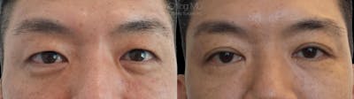 Asian Eyelid Before & After Gallery - Patient 38307420 - Image 1