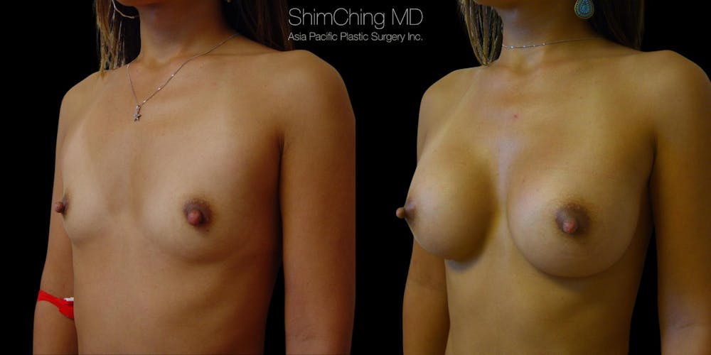 Asian Breast Implants Before & After Gallery - Patient 38307505 - Image 1