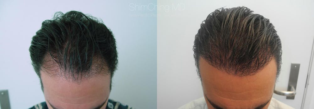 Hair Restoration Before & After Gallery - Patient 38307508 - Image 1