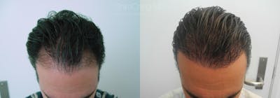 Hair Restoration Before & After Gallery - Patient 38307508 - Image 1