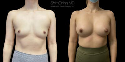 Asian Breast Implants Before & After Gallery - Patient 38307507 - Image 1