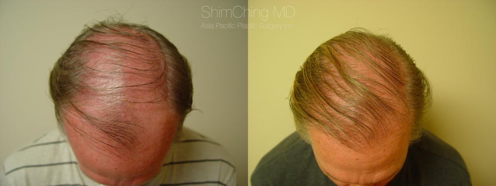 Hair Restoration Before & After Gallery - Patient 38307510 - Image 1