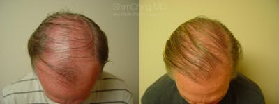 Hair Restoration Gallery - Patient 38307510 - Image 1